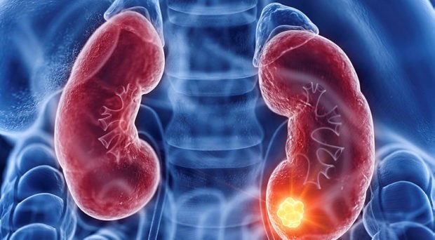 Off-the-shelf CAR-T produces complete remission in patient with advanced kidney cancer - Blog