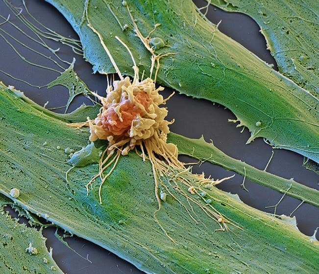 Cancer treatments boosted by immune-cell hacking - Nature - Blog