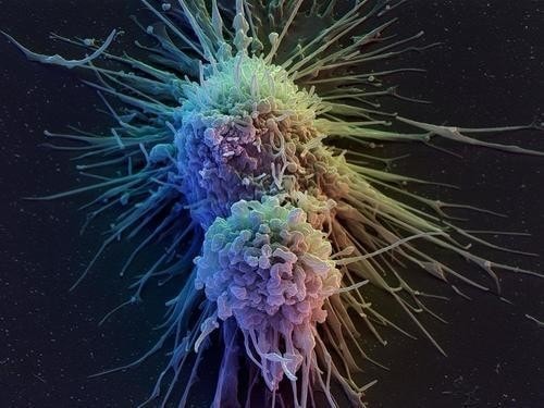 Ovarian cancer patients enrolled in first-in-human trial of CAR T cell therapy - Blog