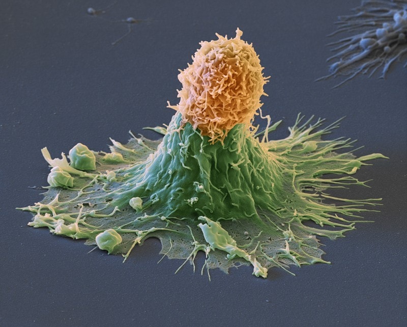 CRISPR-Based Anti-CD19 CAR T-Cell Therapy Is Safe and Effective in Relapsed/Refractory NHL - Blog